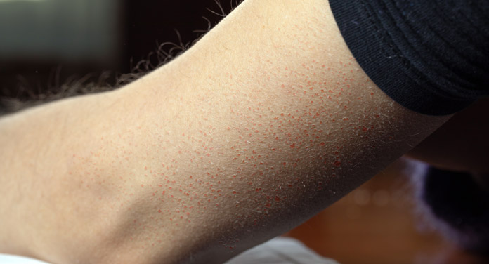 Keratosis Pilaris